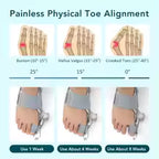 Hallux Valgus Bunion Corrector