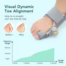Hallux Valgus Bunion Corrector